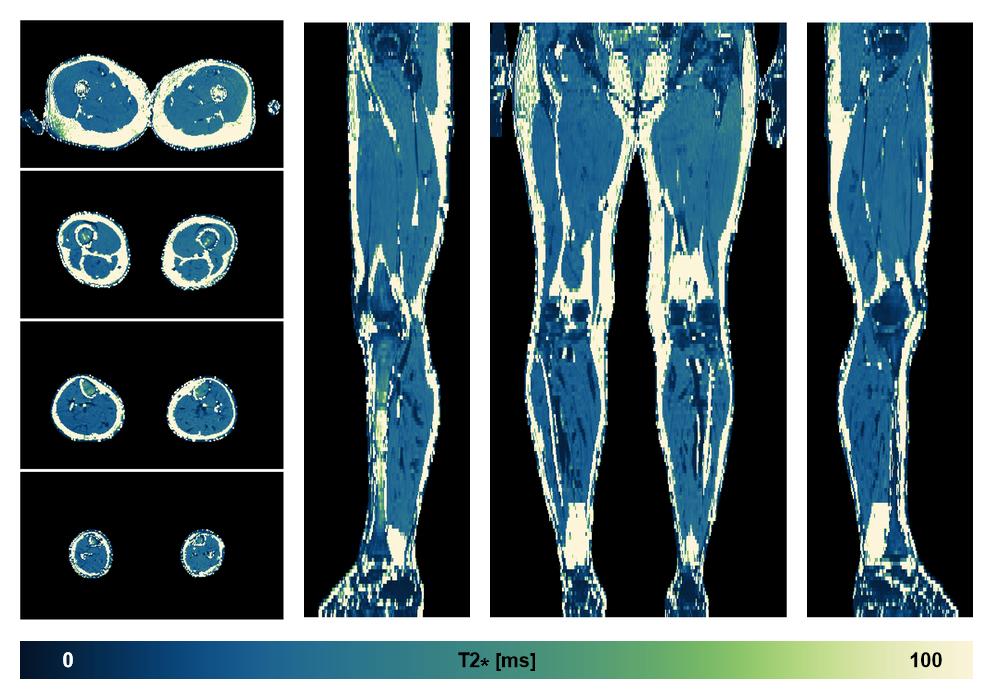 The T2 star relaxation time of the lower extremity obtained from the dixon reconstruction for muscle water fat quantification.